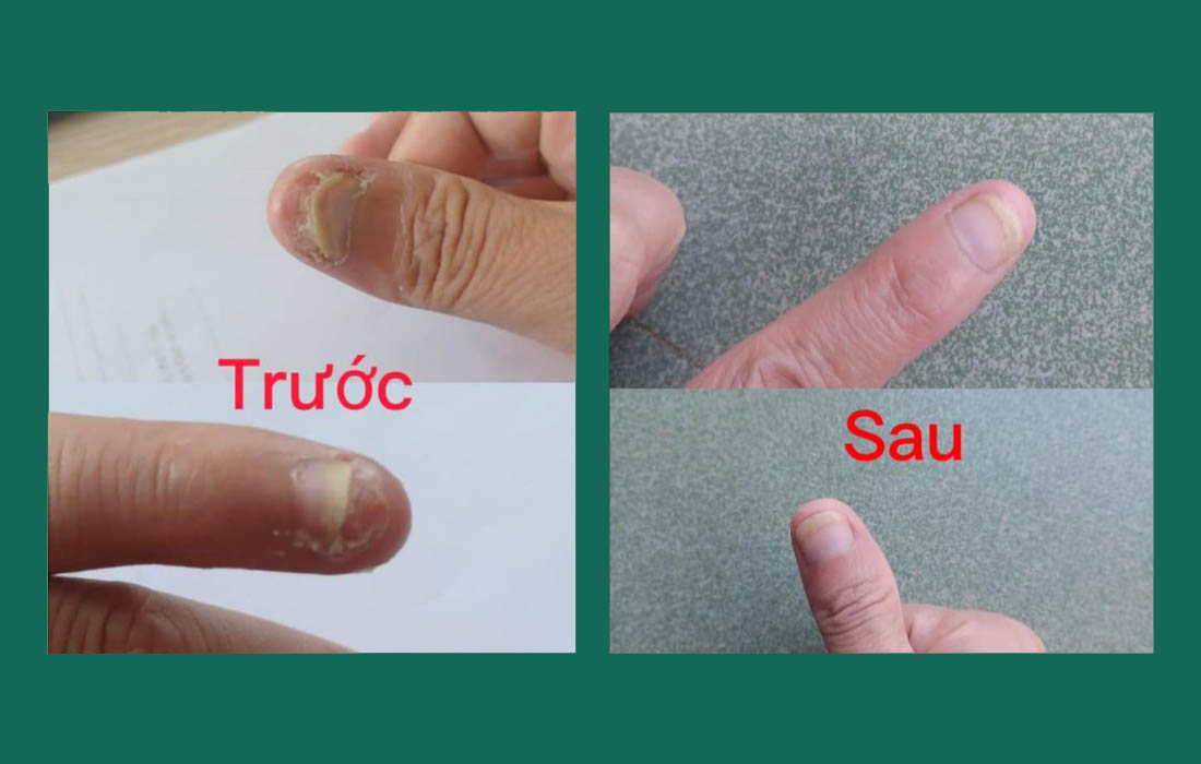 Em Dung: Trị viêm da ngón tay